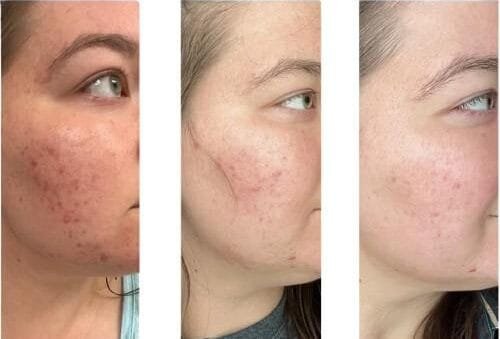 Microneedling Treatment in Miramar